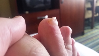 My disgusting blister toenail